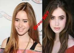 Lily Collins before surgery